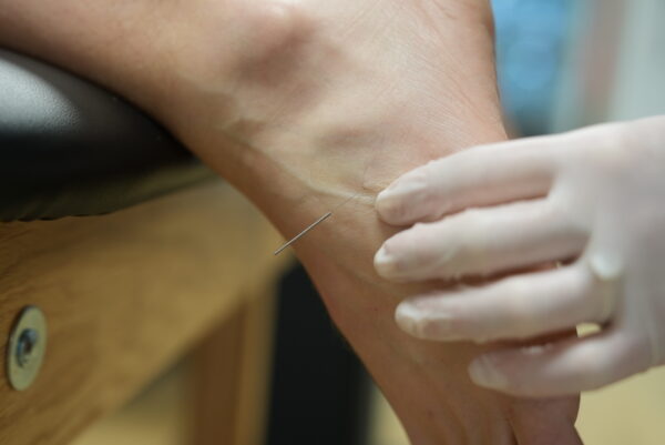 Dry Needling