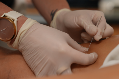 Dry Needling for Foot Pain